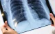 Săptămâna trecută, în capitală au fost înregistrate 14 cazuri de tuberculoză