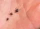 Atenție la căpușe! ANSP a raportat 159 de cazuri de boală Lyme în anul trecut