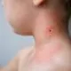 Boala Lyme, principalul pericol transmis de căpușe în Republica Moldova. Recomandările autorităților pentru prevenirea infectării
